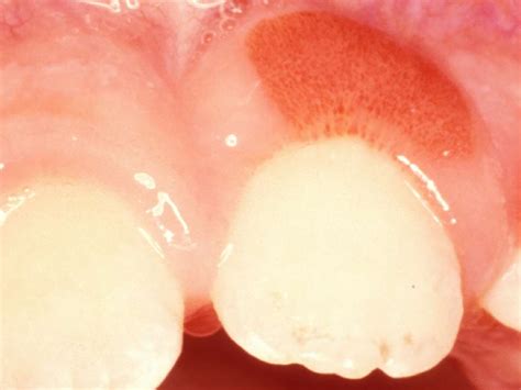 Swollen Gum Around One Tooth What To Know Mckee Dental Associates