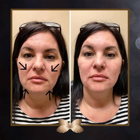 How To Get Rid Of Laugh Lines Utah Facial Plastics