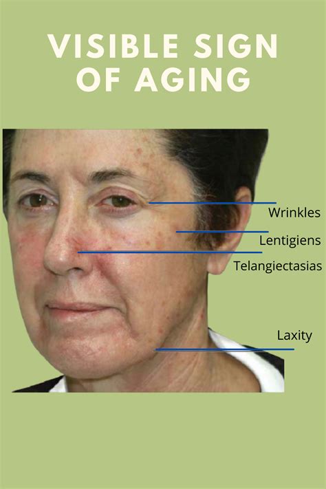Visible Sign Of Aging Aging Signs Facial Therapy Aging