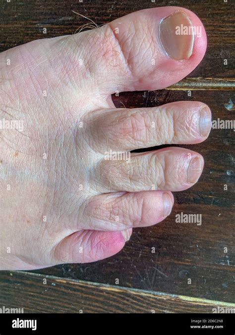 Bruised Fractured Little Toe Of A Man In Close Up Over A Wooden Deck As