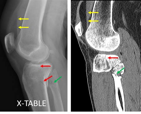 Lateral Tibial Plateau Fracture