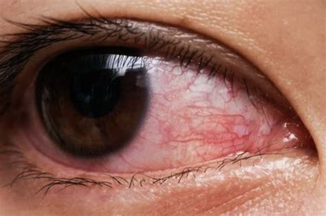 Ochiul roșu și umflat o urgență oftalmologică Cauze și tratament Buna Ziua Iasi BZI ro