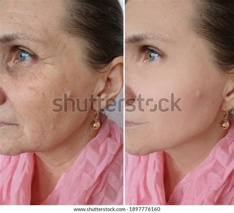 Woman Face Wrinkles Before After Treatment Stock Photo 1897776160