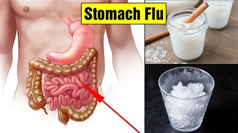 Top 14 Home Remedies For Stomach Fluhow To Get Rid Of Stomach Flu