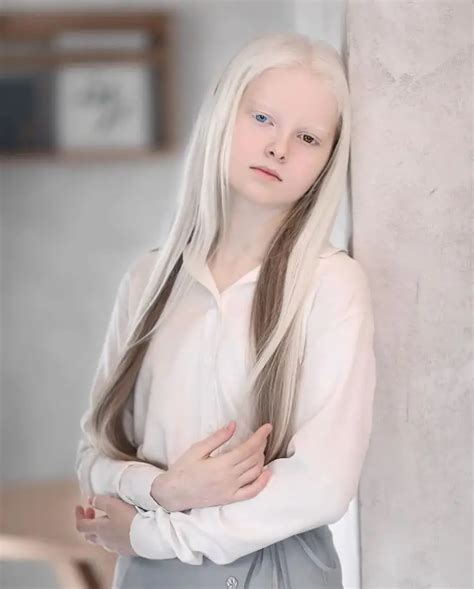Heavenly Photoshoot Highlights The Unique Beauty Of A Girl With Albinism And Heterochromia