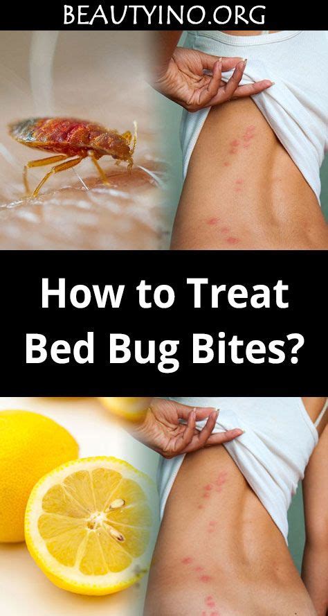 How Long Does It Take To Treat Bed Bug Bites