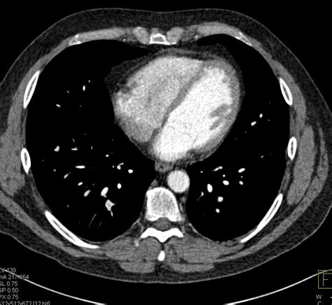 Pulmonary Embolism Pe In Right Lower Lobe Pulmonary Artery In A