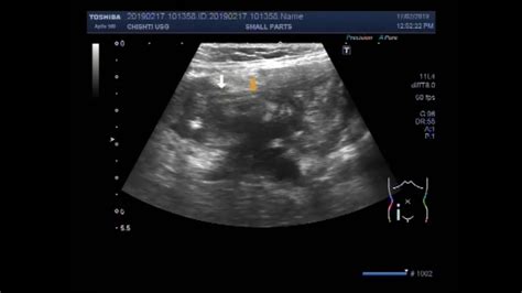 Ultrasound Video Showing Appendicular Mass Youtube
