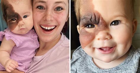 Mom Of Baby With A Rare Birthmark Is Dedicated To Celebrating Her