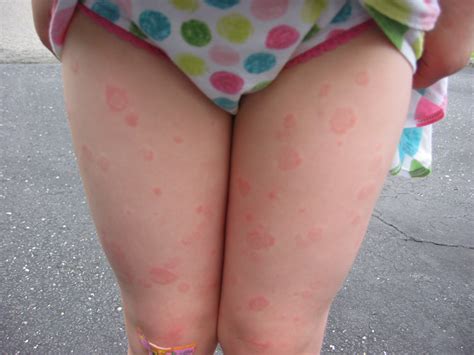 The following are common itchy rashes. round rash on leg - pictures, photos