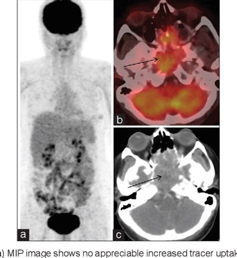 Figure 1 From Extra Renal Malignant Rhabdoid Tumor Of Head And Neck