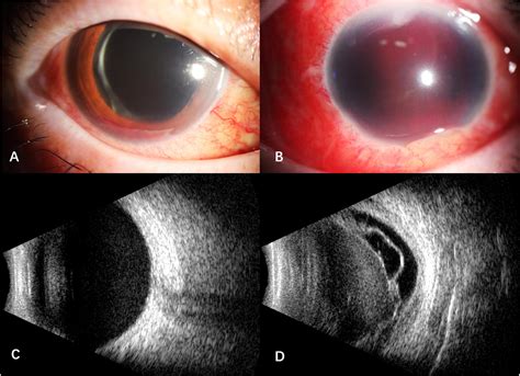 Frontiers Case Report Intraocular Hemorrhage In A Primary