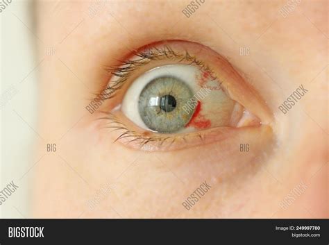 Bloodshot Eye Woman With Burst Blood Vessel In Eye Very Red Bloody
