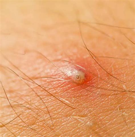 ingrown hair bump on head