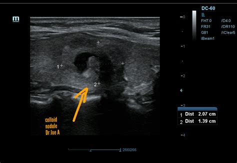 Ultrasound Imaging Colloid Nodules Thyroid