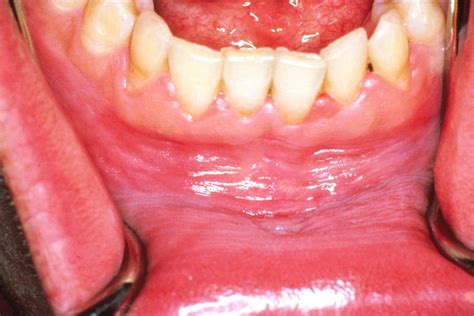 Photos Of Oral Cancer On Floor Of Mouth