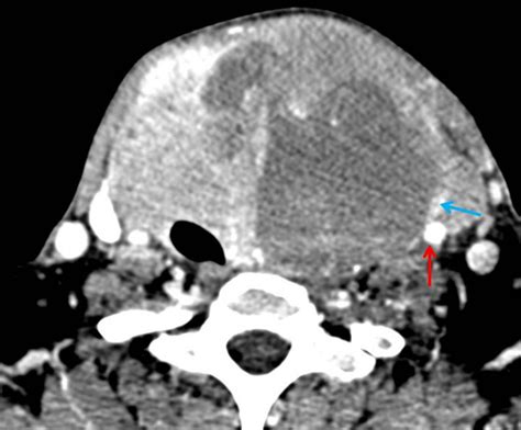 Anaplastic Thyroid Carcinoma Radiology Cases