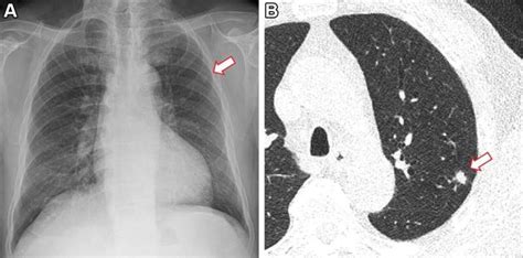 Ai Improves Lung Nodule Detection On Chest X Rays