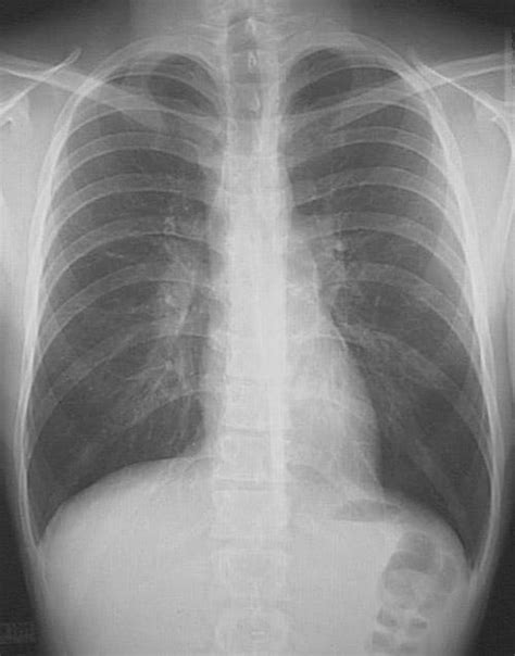 This image shows a normal chest. Mesothelioma