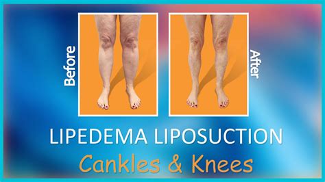 Lipedema Leg Liposuction Results Lipo 360° Cankles And Knees Expert