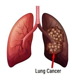 The heart beats faster during exercise and more slowly. Lung Cancer Causes And Symptoms Questions - ProProfs Quiz