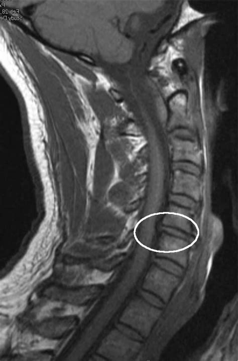 Bulged Disc In Neck Longwood Florida — Premier Performance And