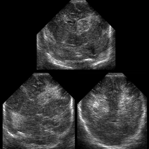 Periventricular Hemorrhage Pediatric Radiology Reference Article