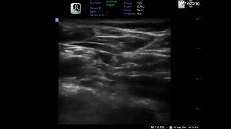 Ultrasound Guided Supraclavicular Brachial Plexus Block Youtube