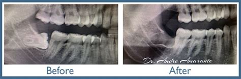 Wisdom Tooth Extraction High Quality Oral Surgeon In Evanston Il