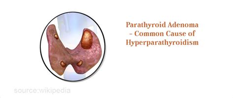 Hyperparathyroidism Causes Symptoms Diagnosis Treatment Prevention