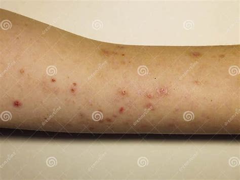 Skin Allergic Irritations In The Form Of A Rash Stock Photo Image Of