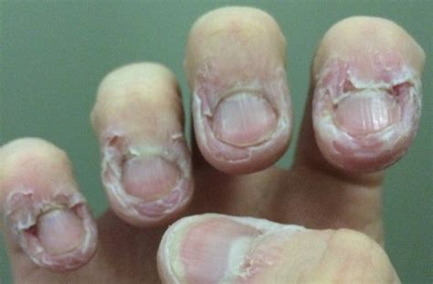 Dermatophagia Biting Skin Around Nails Madeleine Hemmings