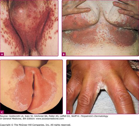Yeast Infections Candidiasis Tinea Pityriasis Versicolor And