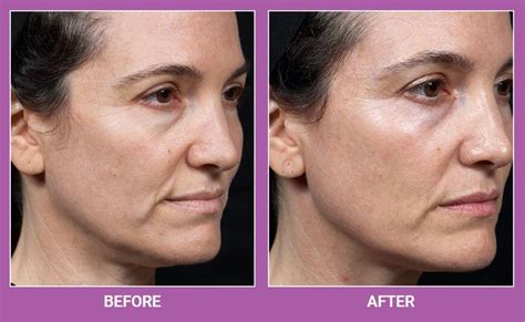 Thermage Flx For Skin Tightening Us Dermatology Partners