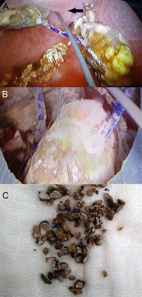 Unusual cause of bladder and urethral stones in a child | BMJ Case Reports