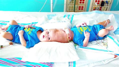Conjoined Twins Separate And Undergo Surgery As Individuals Health