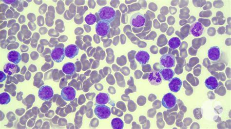 Adult T Cell Leukemialymphoma Marrow