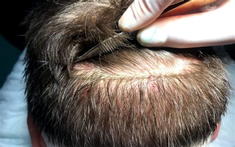 Hair Transplant Insights Arxiv Tsilosani Clinic