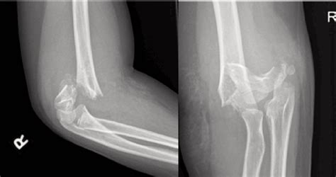 Orthopedics Supracondylar Fracture To The Humerus Medical Sciences