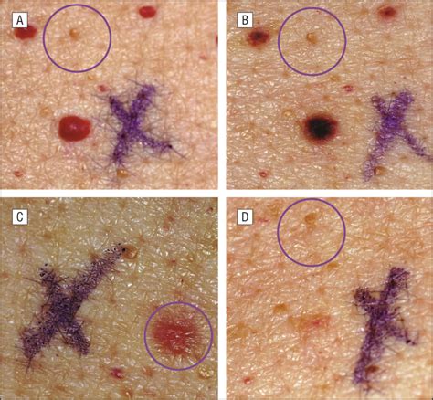 Comparison Of Treatment Of Cherry Angiomata With Pulsed Dye Laser