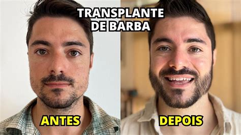 Transplante Capilar De Barba Todos Os Detalhes E Pre Os Youtube