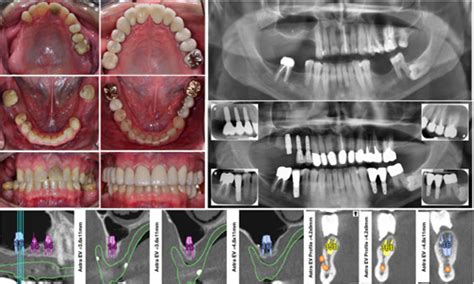 Tooth And Implant Supported Full Mouth Rehabilitation Case Study