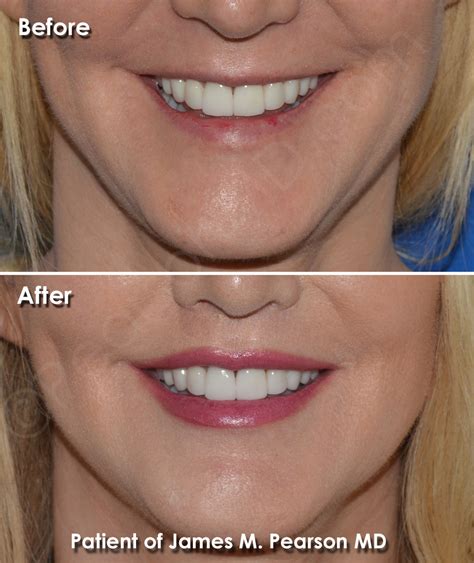 Lip Lift Photos Before And After Dr James Pearson Facial Plastic Surgery
