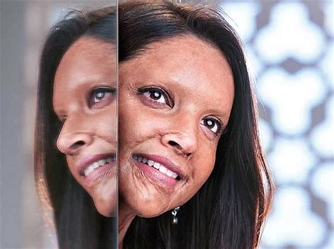 एसिड सर्वाइवर बनने के लिए दीपिका ने करवाया Prosthetic Makeup जानिए कैसे दी जाती हैं यह लुक