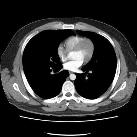 Normal CT Chest Radiology Case Radiopaedia Org