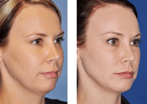 Botox face lift before and after photos look at the pictures of patients before and after botox facelift. Brow Lift Baton Rouge | Dr. Jon Perenack | Endoscopic Surgery