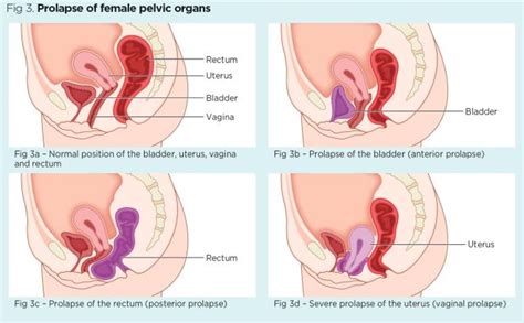 Female Pelvic Floor 1 Anatomy And Pathophysiology Nursing Times