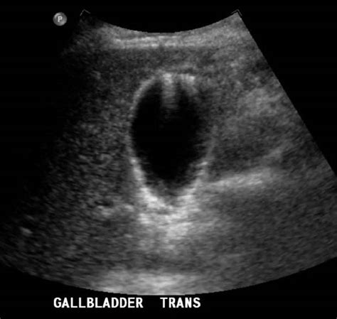 Gallbladder Adenomyomatosis Causes Symptoms Diagnosis Treatment