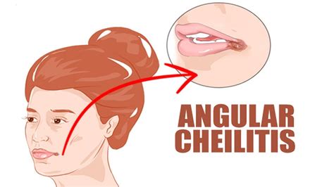 Angular Cheilitis Home Remedy How To Get Rid Of Angular Cheilitis