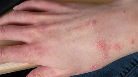 What You Need To Know About Scabies Infection And 10 Parts Of Your Body